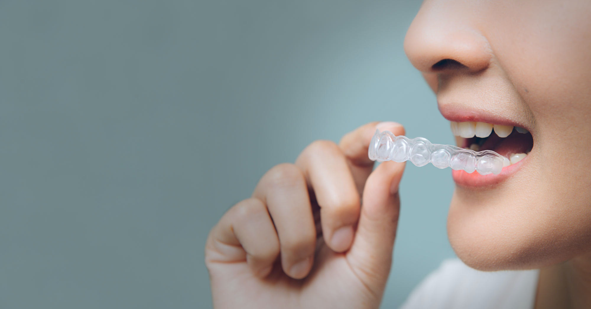 Best Clear Aligners in Rockville Centre, NY